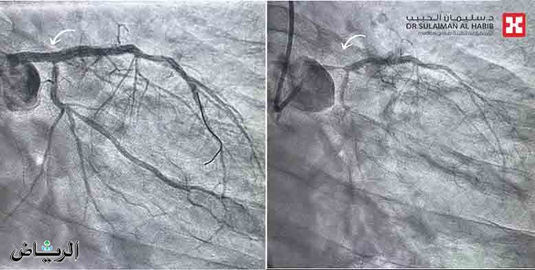 مستشفى سليمان الحبيب ينقذ أربعيني مصاب بانسداد بالشريان التاجي