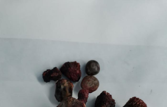 مستشفى الأمير عبد المحسن بالعلا .. إنهاء معاناة مقيم من “الحصوة المرجانية”