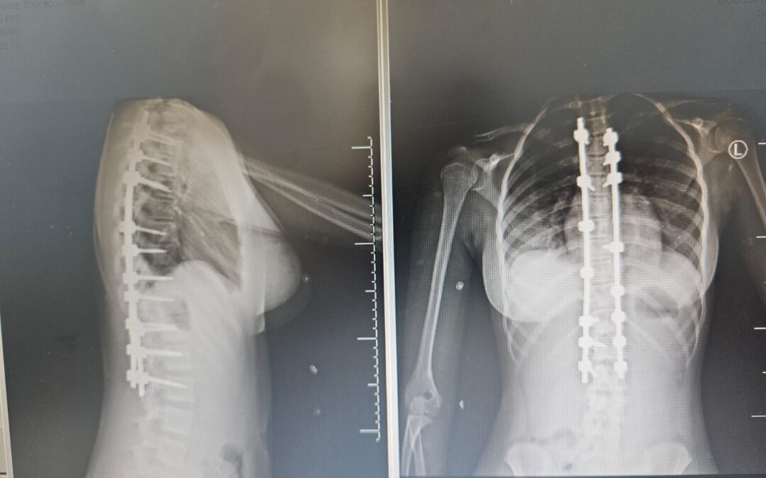 بيشة .. جراحة ناجحة لطفلة تعاني من “الجنف” بمستشفى الملك عبد الله