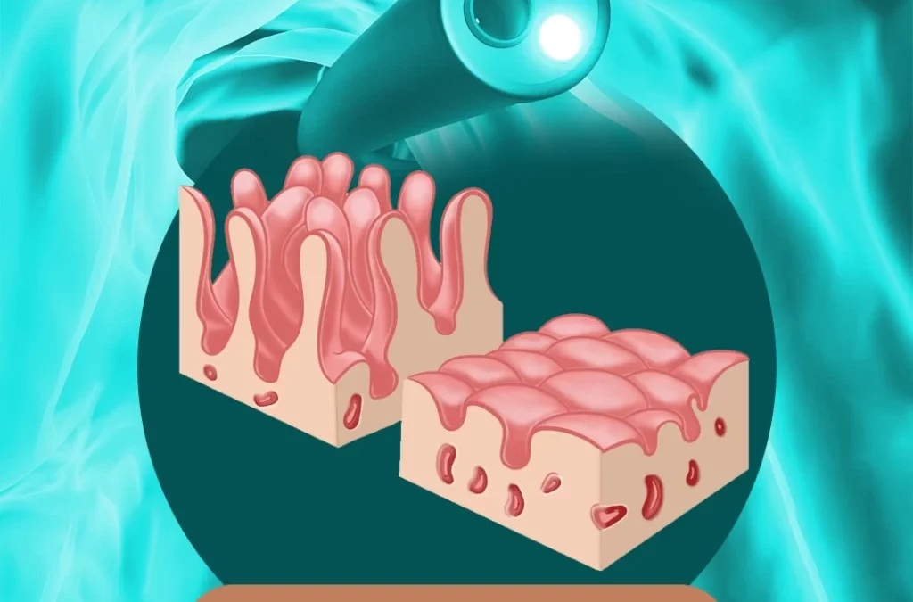 4 أعراض لمرض “السيلياك” يوضحها “تجمع الرياض الصحي”