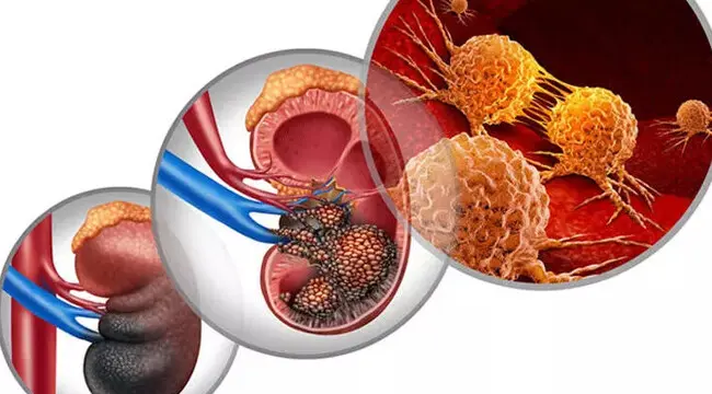 أخصائي أورام الجهاز البولي: هذه 4 أعراض خطيرة لسرطان الكلى