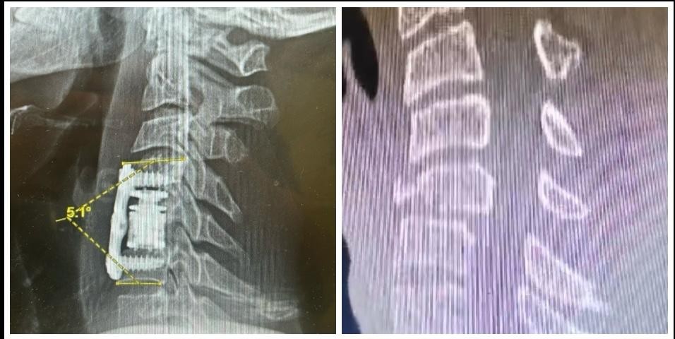 فريق طبي ينقذ شاباً سقط من ارتفاع 6 أمتار بالطائف