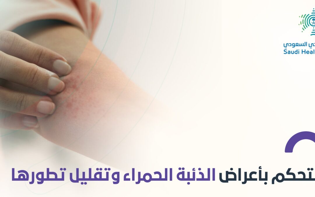 كيف تسيطر على أعراض الذئبة الحمراء