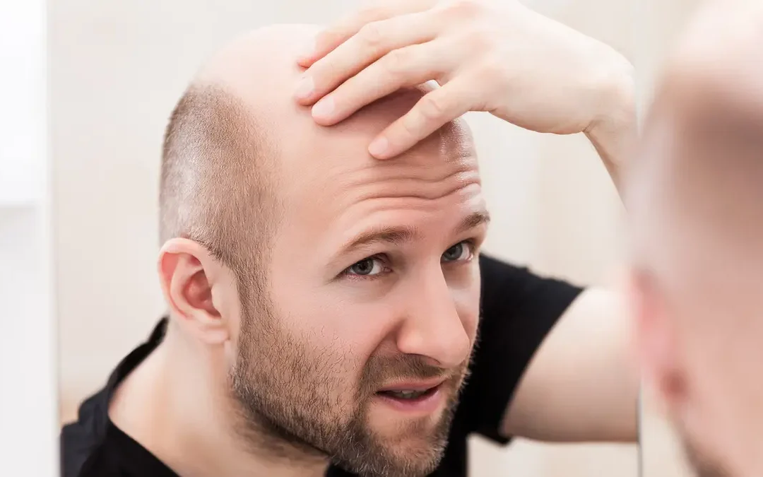 بشكل طبيعي.. علماء يكشفون “طفرة” في علاج الصلع