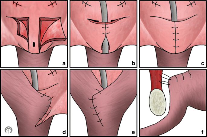 علاج شاب من “سلس البول الكلي” في “مجمع فيصل الطبي” بالطائف