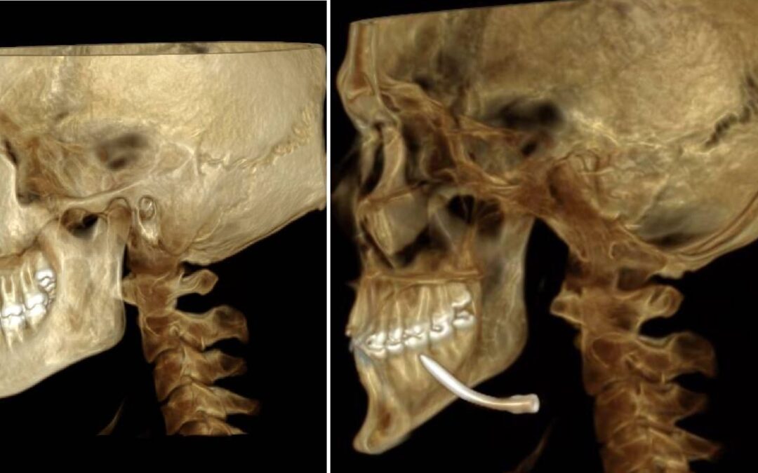 “سعود الطبية” تنزع مسمارًا معدنيًا من قاع فم مريض