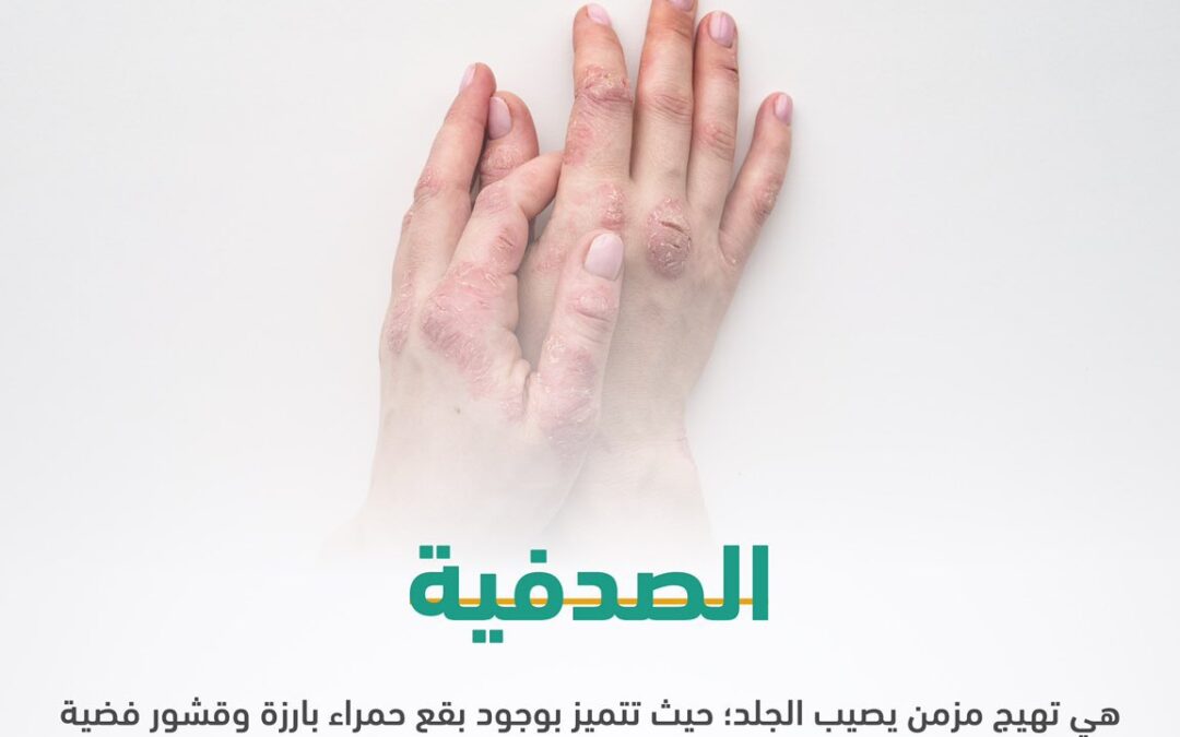 4 حالات تستدعي زيارة الطبيب.. أعراض وطرق الوقاية من الصدفية