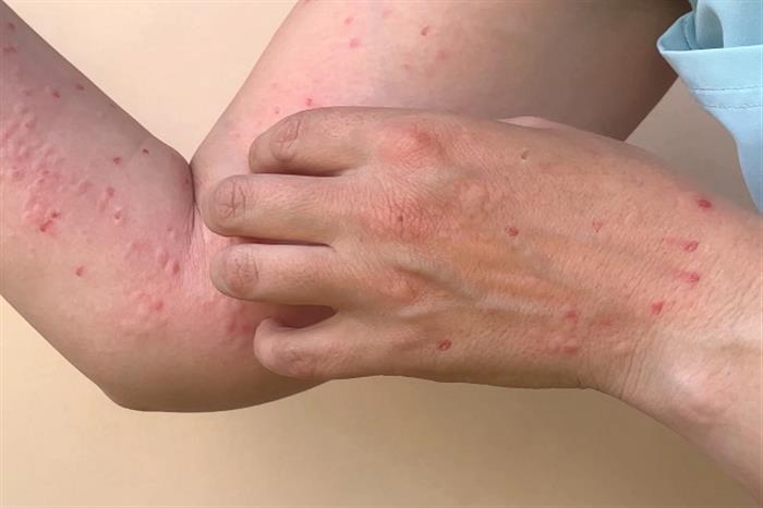 الاتحاد الأوروبي يستبعد اتخاذ تدابير استثنائية لمواجهة جدري القرود