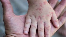 “جدري القردة”.. “الهند” توصي بتوخي الحذر في المطارات والموانئ