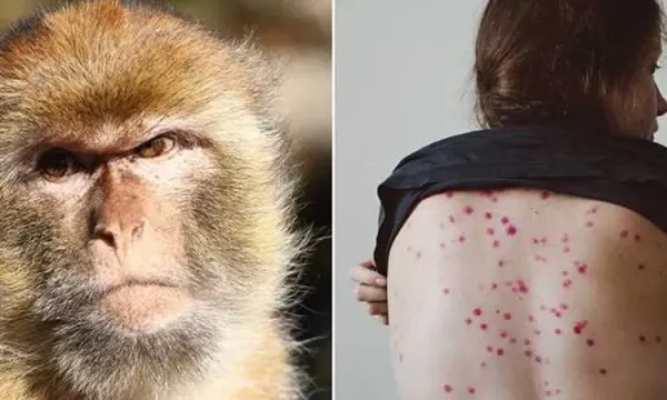 الفلبين تسجل أول إصابة بجدري القرود