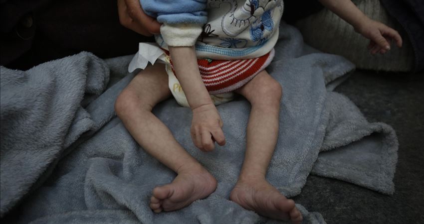 وفاة الطفلة “يقين” ترفع ضحايا سوء التغذية في غزة إلى 37