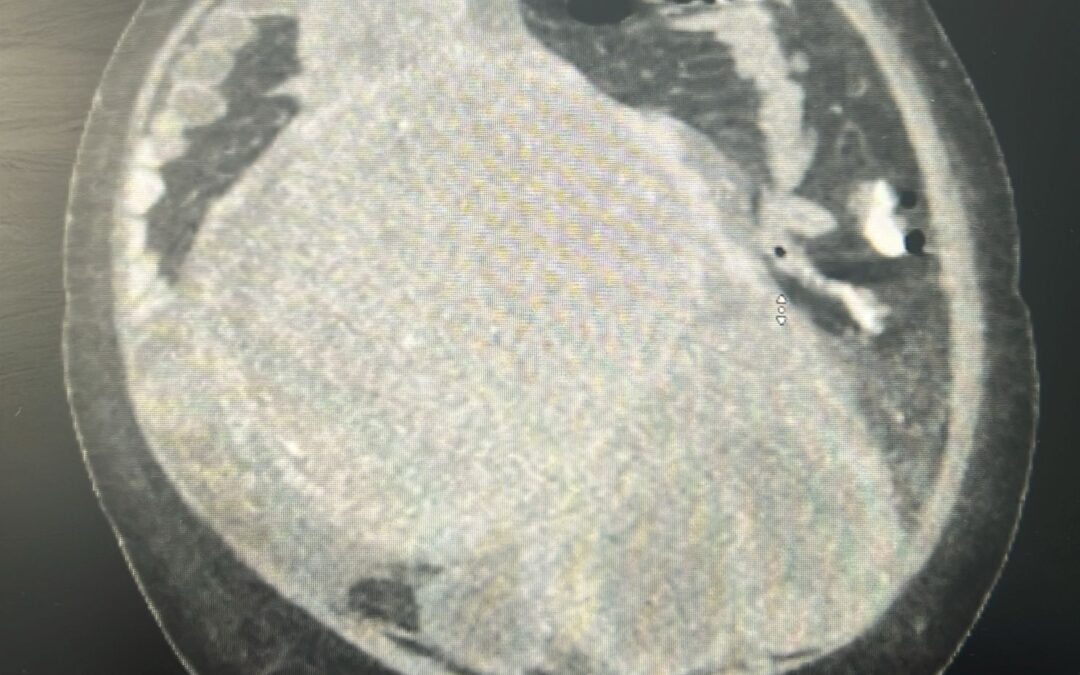 14 كغم.. “استئصال ورم ضخم” من بطن امرأة في مجمع الملك فيصل بالطائف