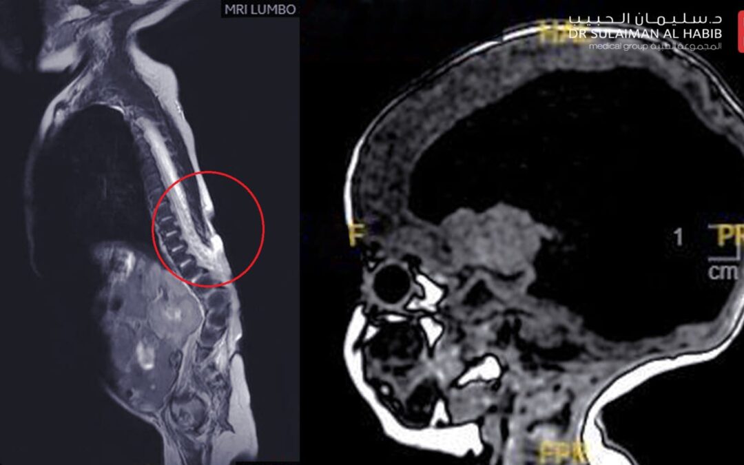 مستشفى الحبيب بالقصيم يُجري عمليةً معقدة ناجحة بالعمود الفقري لإنقاذ رضيع من تَبِعَات تشوه خلقي