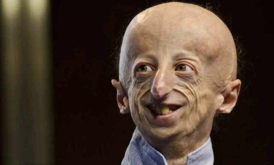 “سامي باسو” أكبر مصاب بمتلازمة الشيخوخة المبكرة في العالم يفارق الحياة