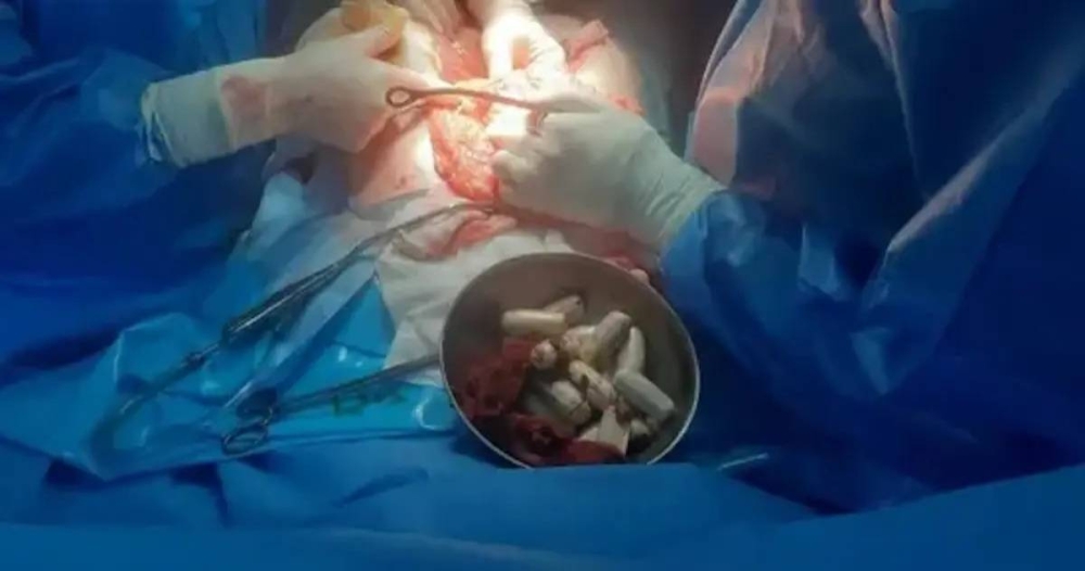 إيران.. استخراج 100 عبوة مخدرة من بطن شاب