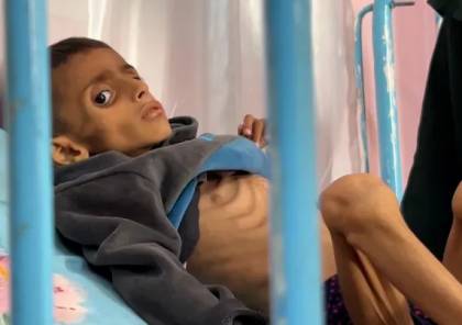 الأمم المتحدة: وفاة 8 أشخاص في غزة خلال 24 ساعة بسبب سوء التغذية